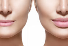 Lip Lift: Η μικροεπέμβαση που αναβαθμίζει το πρόσωπο