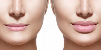 Lip Lift: Η μικροεπέμβαση που αναβαθμίζει το πρόσωπο