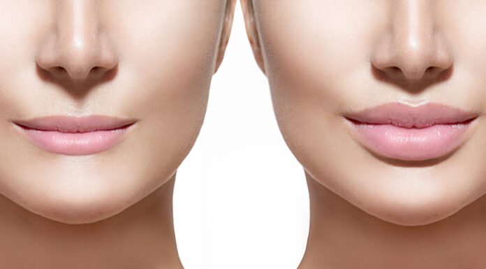 Lip Lift: Η μικροεπέμβαση που αναβαθμίζει το πρόσωπο