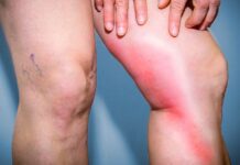 Κάθε 6 δευτερόλεπτα χάνεται μία ζωή από επιπλοκές θρόμβων